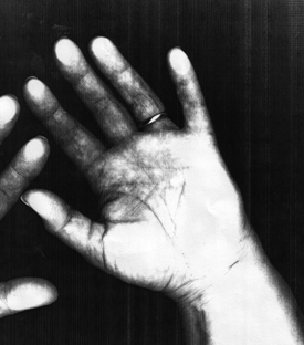Arnett's hand image